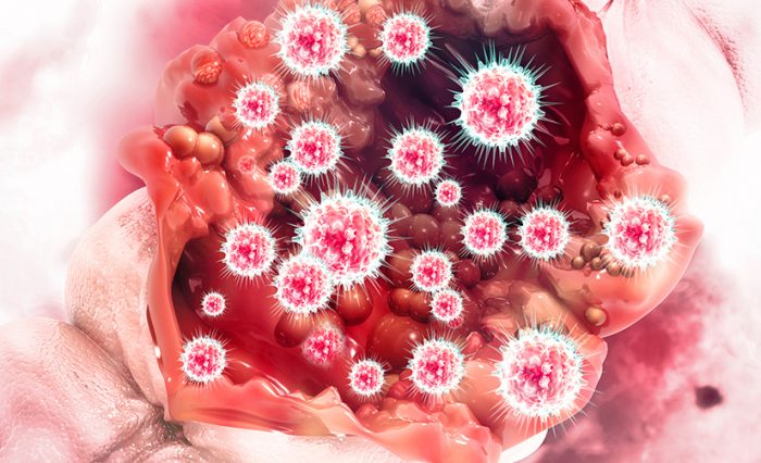 STIRE - Colorectal Cancer